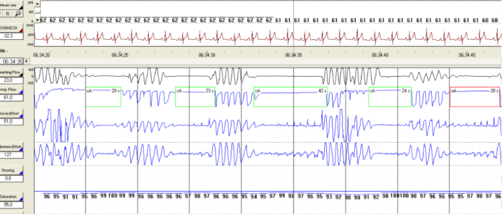 Polysomnography in a patient with obsrtuctive sleep apnea. Κεντρικές, μικτές και αποφρακτικές άπνοιες και αποκορεσμοίΚεντρικές, μικτές και αποφρακτικές άπνοιες και αποκορεσμοί