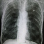 Chest xray of Emphysema - Ακτινογραφία θώρακος ασθενούς με εμφύσημα