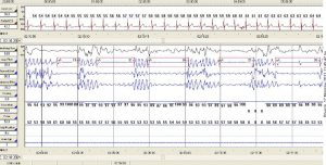 Polysomnography (sleep study) in a patient with obstructive sleep apnea in Limassol Cyprus