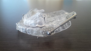 Mandibular Adavncement Devise, Mandibular Repositioning Device, MRD