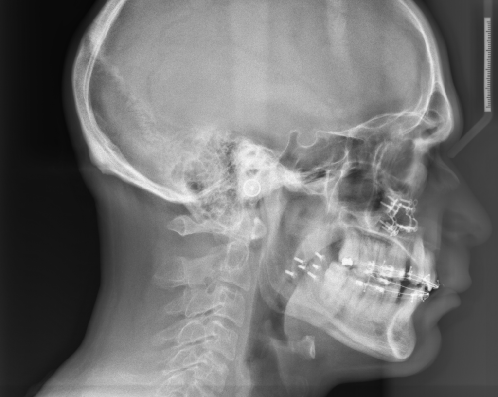 Πλάγια κεφαλομετρική ακτινογραφία μετά από επέμβαση μετατόπισης γνάθων
