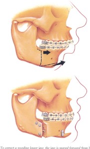 Χειρουργική προώθηση της κάτω γνάθου - Mandibular repositioning